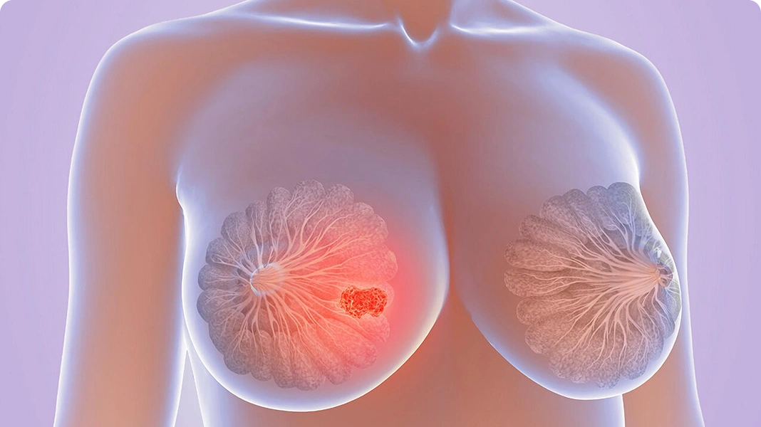 3D medical imaging showing breast tissue with a highlighted tumor area on the left breast