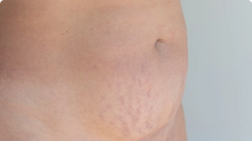 Purple rash or bruising on skin